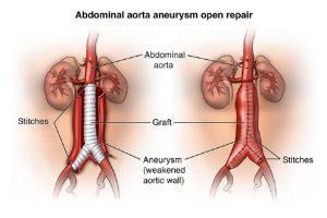 abdominal aorta, aorta aneurysm