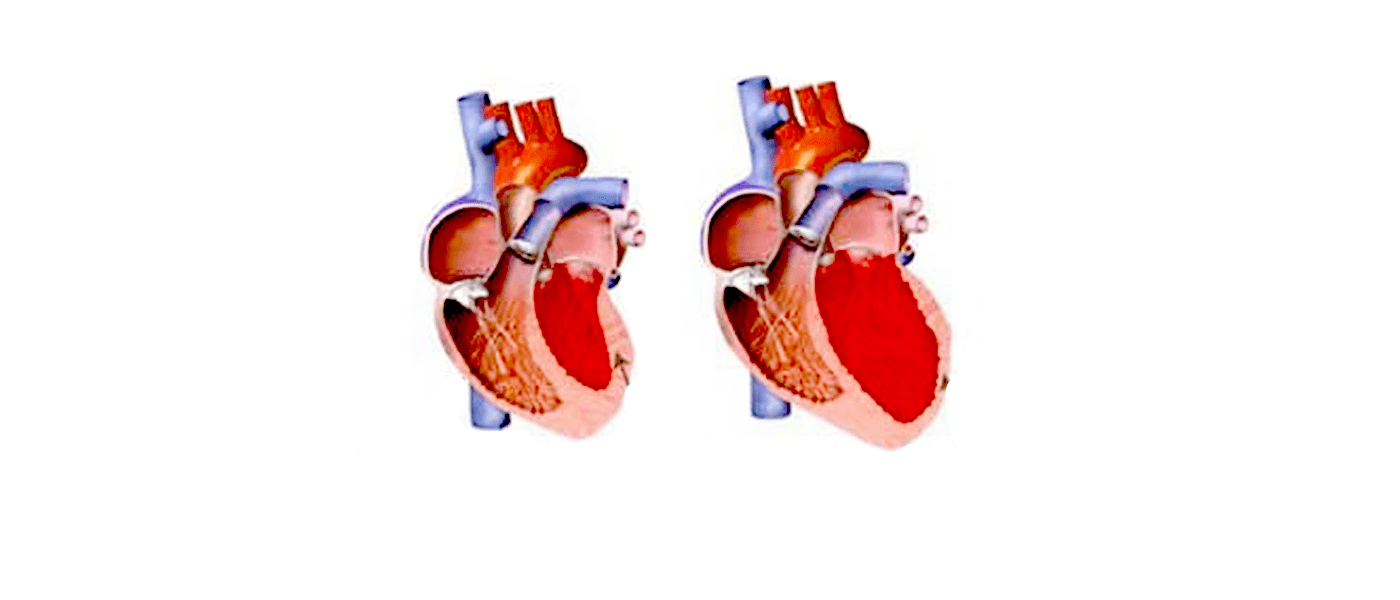 Aortic Valve Repair surgery in India, Cardiac, Replacement