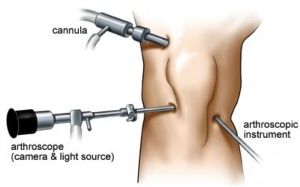 Arthroscopy in Knee Injuries