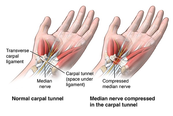 Carpal Tunnel Decompression