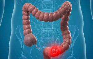 Chemotherapy for Colon Cancer