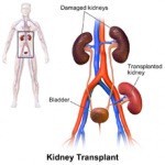 Kidney Transplantation Treatment In India