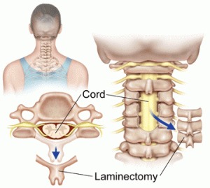 Laminectomy Spine Surgery_11zon