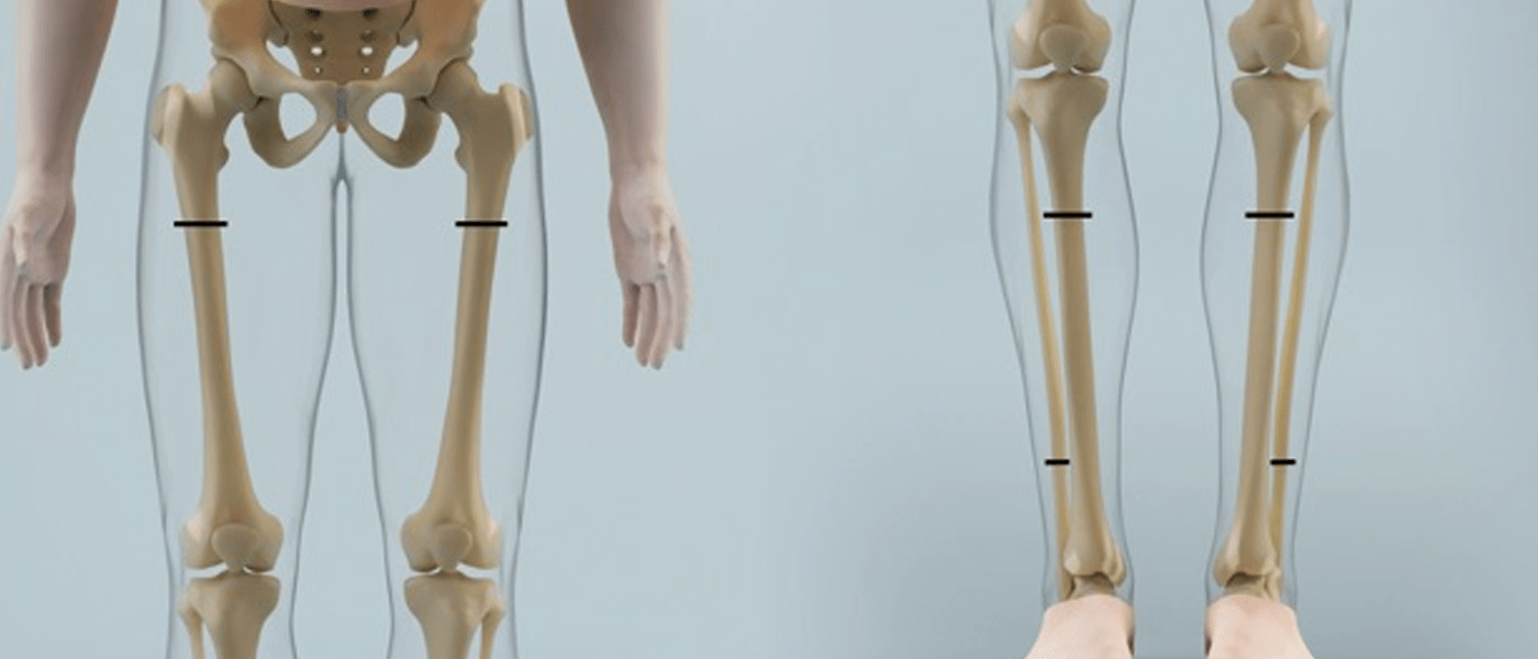 Bone Transport  International Center for Limb Lengthening