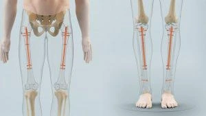 Limb Lengthening Treatment in India 11zon