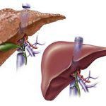 Liver Transplantation Treatment in India