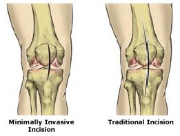 Minimally Invasive knee replacement surgery