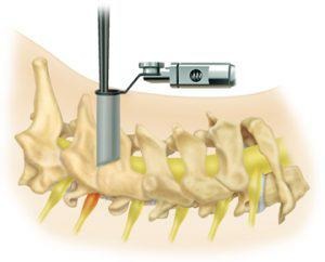 Posterior Microdiscectomy for Cervical Spine_11zon