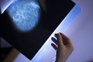 Radiation Therapy For Breast Cancer