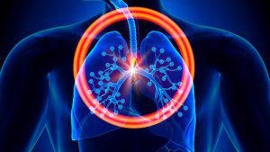 Radiation Therapy for Lung Cancer
