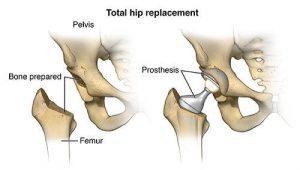 total hip replacement