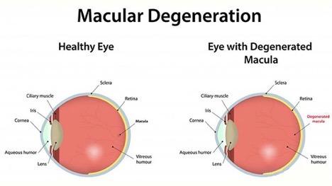 Macular Degeneration Hospital & Doctors in India - HBG Medical Assistance