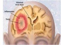 Brain-tumour