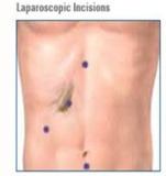 (Laparoscopic) Cholecystectomy