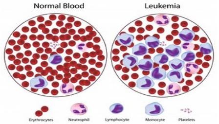 chronic Lymphocytic Leukemia