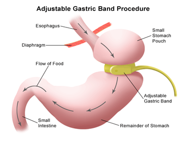 Adjustable Gastric Banding