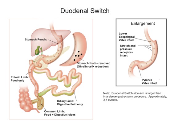 Duodenal Switch