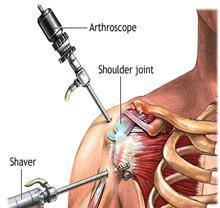 Arthroscopic Shoulder Surgery 