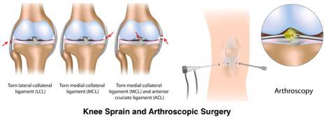Arthroscopy in knee injuries