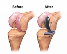 Cartilage Repair or Restoration