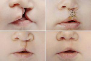 Cleft Lip and Palate Repairs