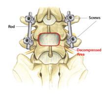 Decompression and Spine Fusion