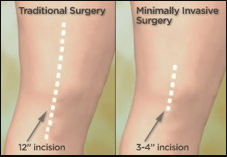 Minimally Invasive Knee Replacement surgery