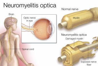 Neuromyelitis Optic