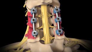 Posterior Cervical Laminectomy