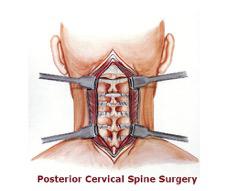 Posterior Microdiscectomy for cervical spine