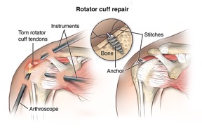 Rotator Cuff Tear Treatment & Surgery in Noida