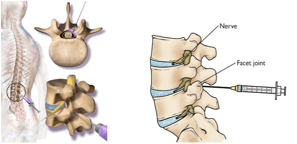 Steroid Injections for Spine Treatment