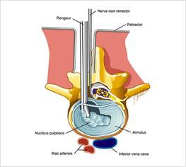 Spinal Decompression Surgery