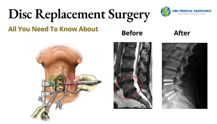 Disk replacement Surgery in India