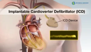 CRT-D Implant in India